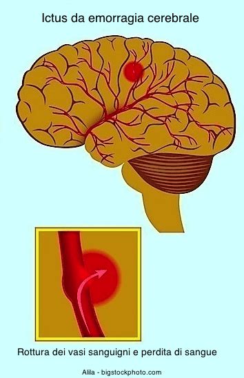 Emorragia Cerebrale Sintomi Ictus Cause Conseguenze Aneurisma