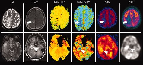 Brain Perfusion Imaging How Does It Work And What Should I Use