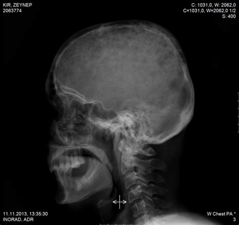 Atypical Presentation of Plasmacytoma