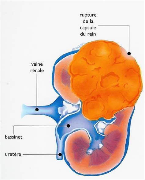 Cancer Du Rein Ue 29 Processus Tumoraux Dr Jp Fendler