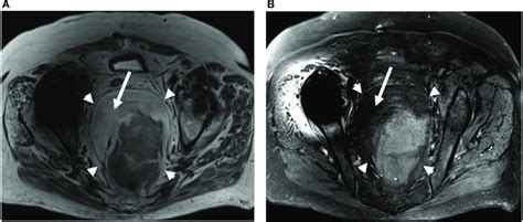 Axial Nonfat Saturated A And Fat Saturated B T2 Weighted Mri Download Scientific Diagram