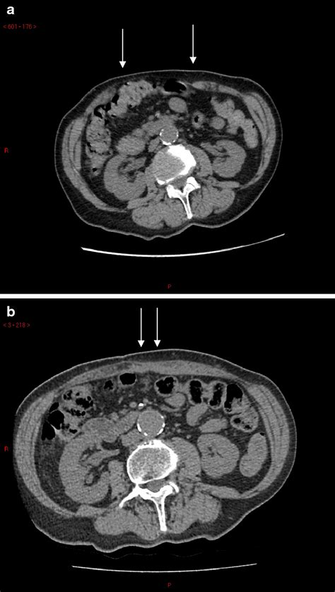 Peritoneal Flap Hernioplasty For Reconstruction Of Large Ventral Hernias Long‐term Outcome In