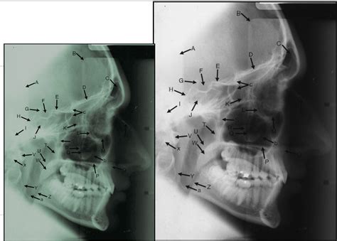 Radio Lateral Ceph Image ID Diagram | Quizlet