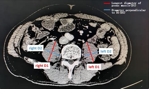 Assessment Of The Psoas Muscle Index Pmi Sarcopenia Was Assessed By