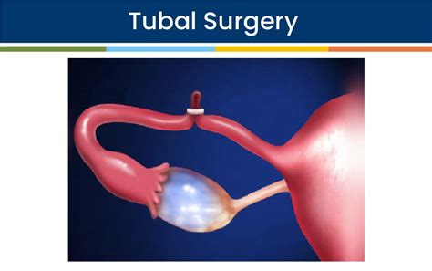 Tubal Cannulation Orkid Medilife Hospital