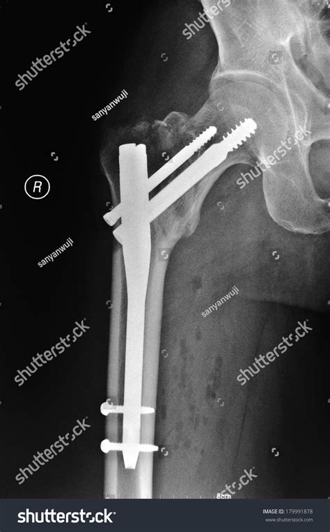 Right After Femoral Neck Fracture Surgery Stock Photo 179991878 ...