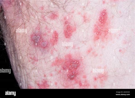 Close Up Of A Shingles Rash Of Blisters On The Skin Of The Leg In An 85