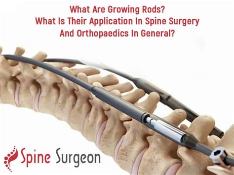 What are growing rods? What is their application in spine surgery and ...