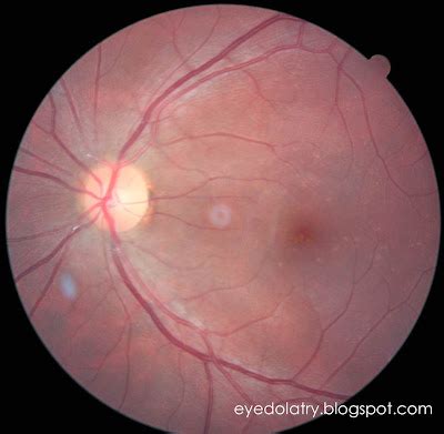 Retinal Photography - Eyedolatry