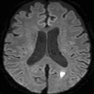 Diffusion Weighted Magnetic Resonance Imaging Of The Head Reveals A