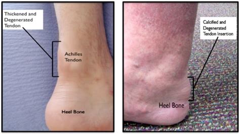 Achilles Tendinitis Causes Picture Symptoms And Treatment