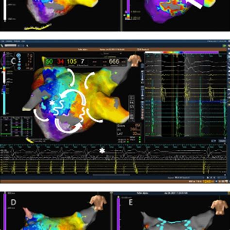 High Density Activation A And Voltage Map B Of A Left Atypical Afl