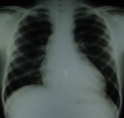 Dilatation of ascending aorta – All About Cardiovascular System and Disorders