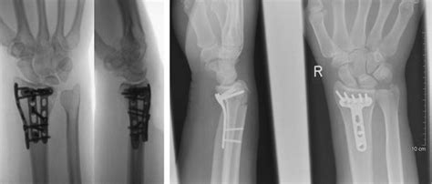 Postoperative X Rays Of A Dorsal Ao 23 C3 Left And Volar Locking Download Scientific