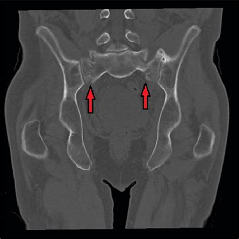 Bilateral Sacral Fractures In Line With Arrows Are Clearly Visualized Download Scientific