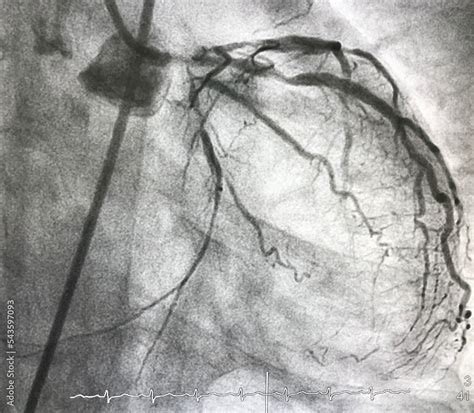 Coronary Angiography Shown Left Main LM Stenosis With Triple Vessel