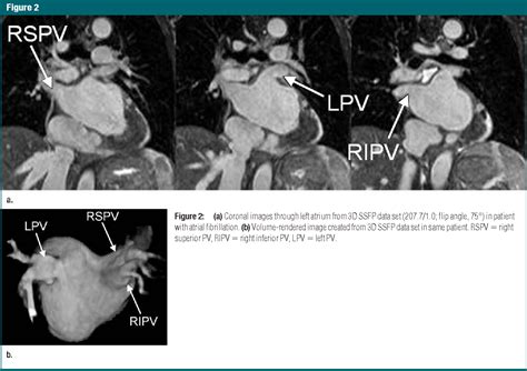 Figure 2 From Pulmonary Vein Imaging With Unenhanced Three Dimensional