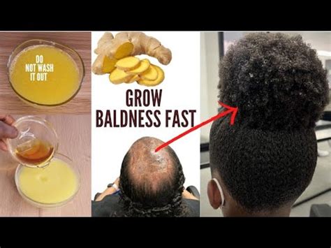 How I Use The Ginger Juice Treatment To Grow Back Alopecia Baldness