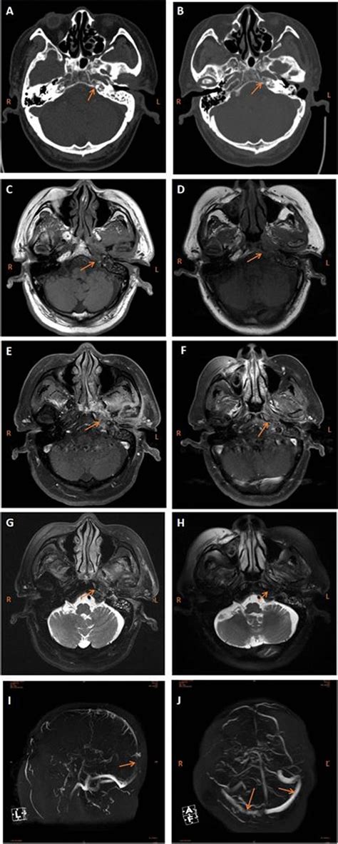 Image Of The Patient A And B Pre And Post Operative Ct Scan Images Of