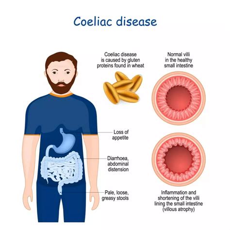 Celiac disease - NabahaKatalina