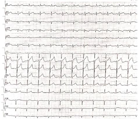 Electrocardiography Revealed Sinus Rhythm Low Limb Voltage And A Poor