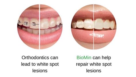 Gc Tooth Mousse Tooth Mousse Plus Mi Paste Plus