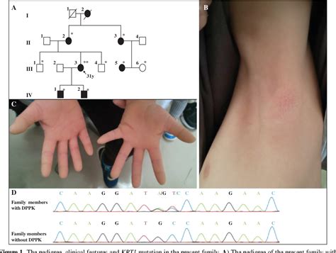 Figure 1 From Identification Of A Novel Causative Mutation In Krt1 In