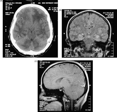 A Ct Scan Of Head Non Contrast Showing Hypodensity Involving