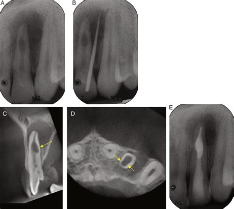 Internal Root Resorption A Review Journal Of Endodontics