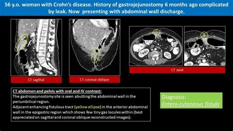 Iatrogenic Entero Cutaneous Fistula References Clinical Imaging Hamad