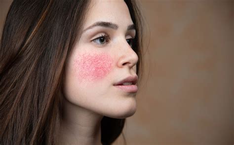 9 Common Skin Diseases and How to Treat Them | Fashionisers©