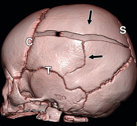 Lateral Skull Fracture