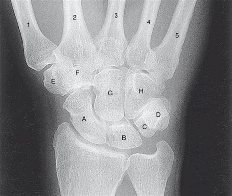 X Ray Anatomy Pa Wrist Diagram Quizlet