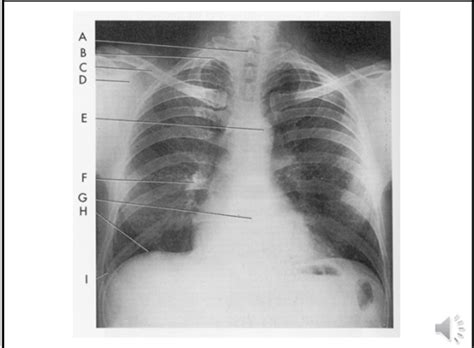 Ap Chest Radiograph Diagram Quizlet