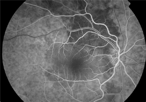 Fundus Fluorescein Angiography Ffa Of The Re Early Frames Showing