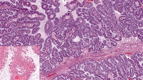 Ovarian Tumor Histiology