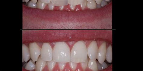 Monitoring the Color Stability of Dental Composite Resin with Spectral Technology | HunterLab