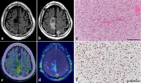 Glioblastoma, IDH wild type in a 66-year-old man (case 4). Axial MRI in ...