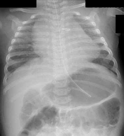 Patent Ductus Arteriosus Clip Radiology Case Radiopaedia Org Clip