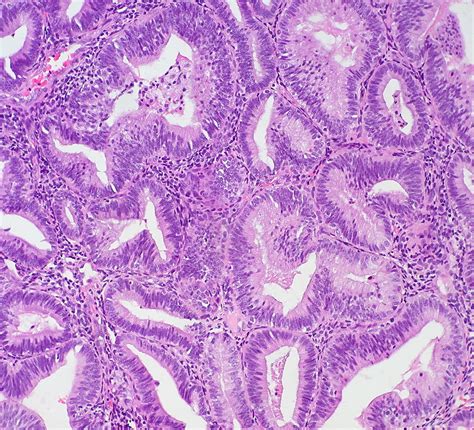 Atypical Endometrial Hyperplasia