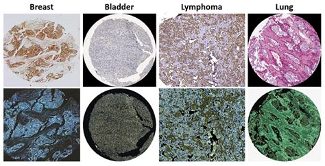 Histopathological Classification Of Cancer Via Deep Learning Dias