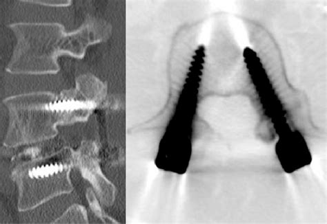 Postoperative 6 Months Follow Up 3d Reconstruction And Axial Ct Images