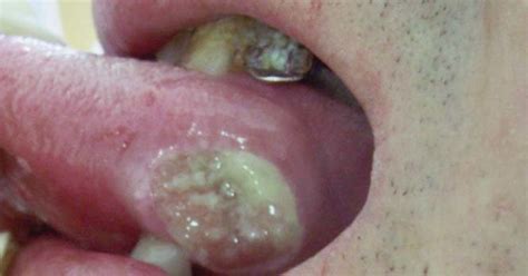 Ulcer Under Tongue