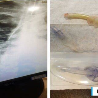 Chest X Ray Showing Fragmented Tracheostomy Tube Migrated To The Left