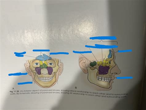 Sinus Labeling Diagram Quizlet