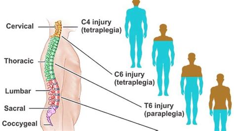 Mengenal Spinal Cord Injury Atau Cedera Saraf Tulang Belakang Yang Juga