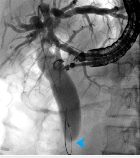 Cholangiogram Showing A Dilated Biliary Tree With Distal Bile Duct Download Scientific Diagram