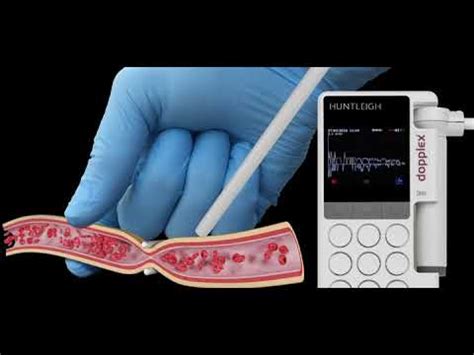 Arjo Announces New Single Use Intraoperative Doppler System