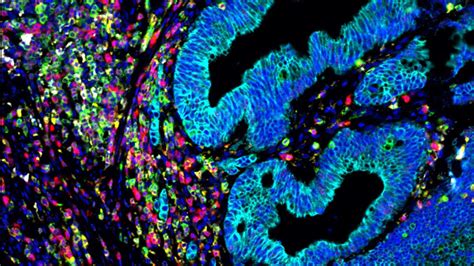 Spatial Phenotyping Of The Tumor Microenvironment Implications For