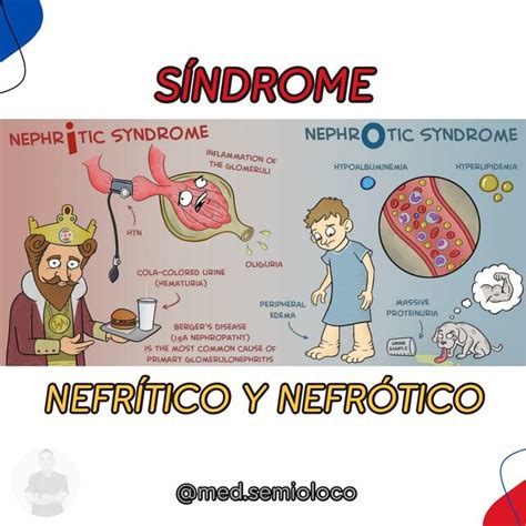 Síndrome Nefrítico y Nefrótico Víctor Rodriguez Botero med